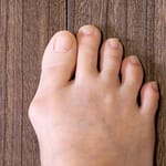 泉大津 松之浜整骨院 外反母趾